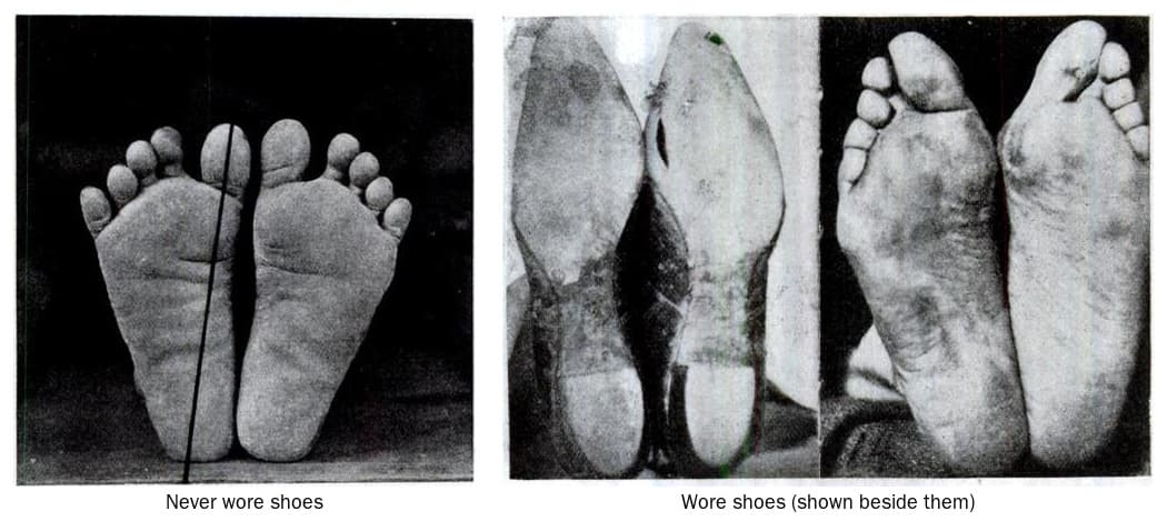 Two pairs of feet photographed in 1905. Left, the soles of someone who never wore shoes, toes straight and spread. Right, feet that wore narrow shoes, shown beside the shoes, the toes pressed into their shape.
