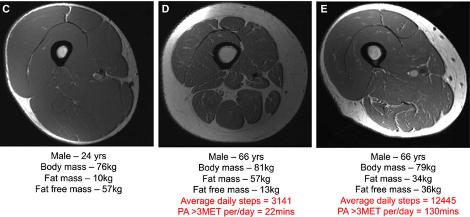 Three MRI scans of a cross-section through the thigh. A 24-year-old man's thigh is almost all dark muscle. An inactive 66-year-old's thigh has much smaller muscles wrapped in a thick pale ring of fat. An active 66-year-old who walks over 12,000 steps a day keeps more muscle, but still less than the young man.